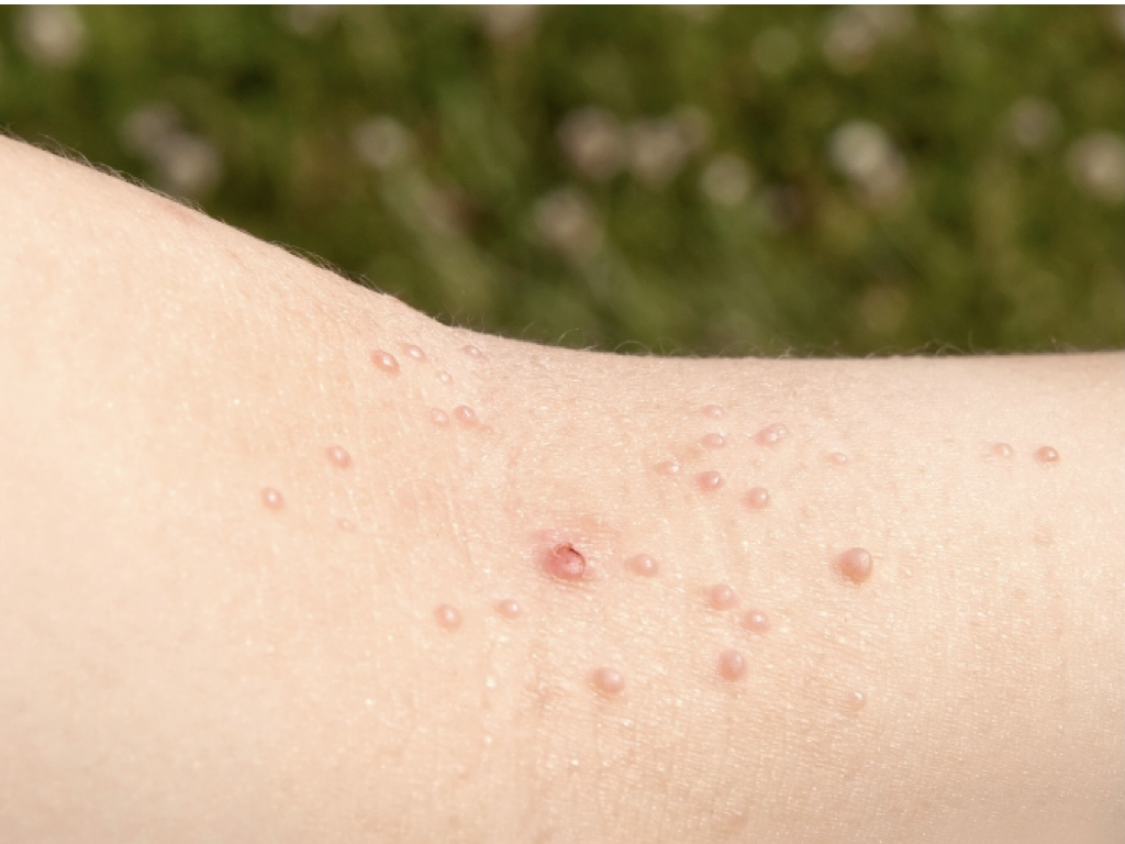 Molluscum Contagiosum